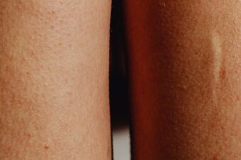 Narbe nach Schönheits OP