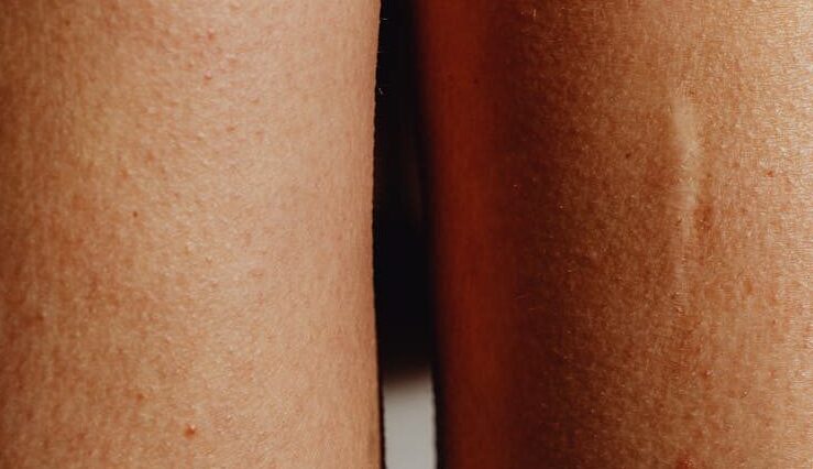 Narbe nach Schönheits OP