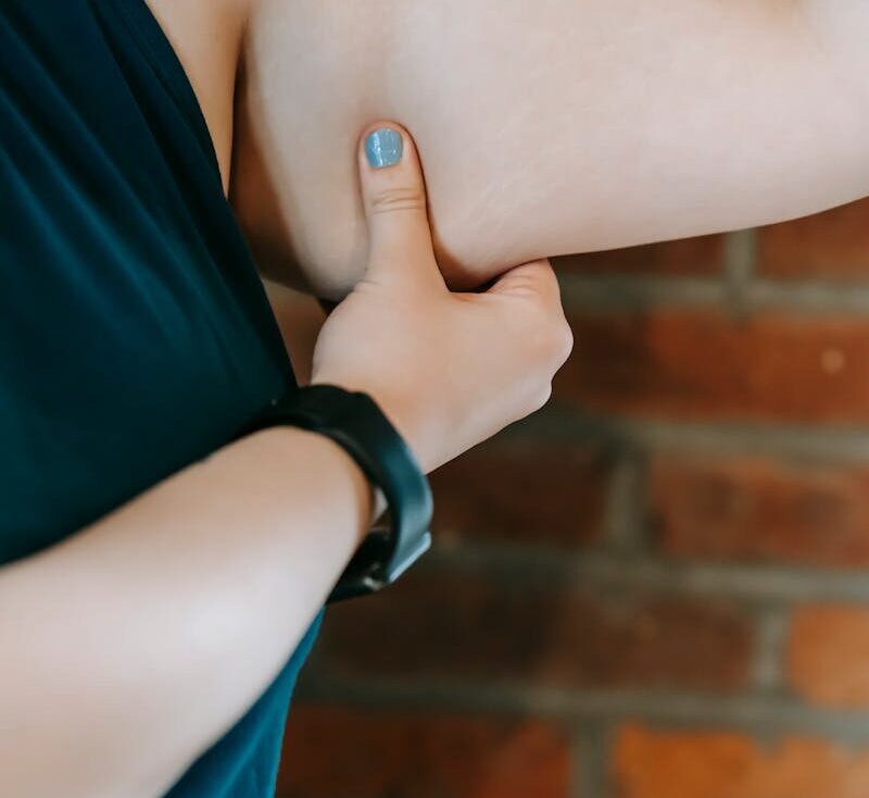 Lipödem-Liposuktion als Kassenleistung: Was der G-BA-Beschluss für ästhetisch-plastische Praxen bedeutet