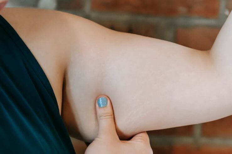 Lipödem-Liposuktion als Kassenleistung: Was der G-BA-Beschluss für ästhetisch-plastische Praxen bedeutet